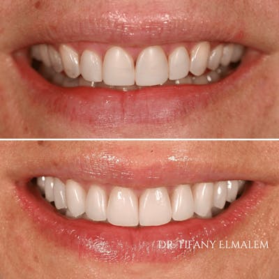 Cosmetic Services Gallery Before & After Gallery - Patient 379948 - Image 1