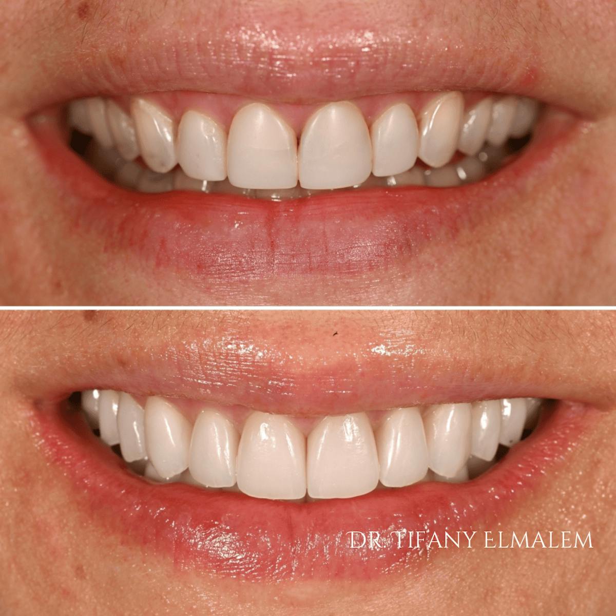 Cosmetic Services Gallery Before & After Gallery - Patient 379948 - Image 1