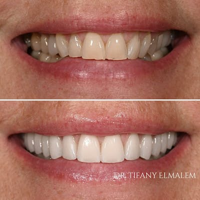 Cosmetic Services Gallery Before & After Gallery - Patient 181746 - Image 1