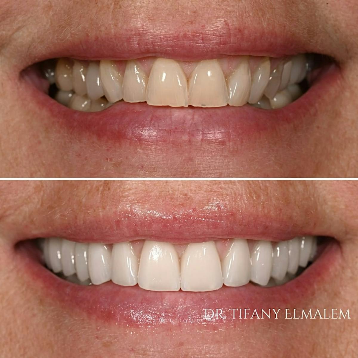 Cosmetic Services Gallery Before & After Gallery - Patient 181746 - Image 1