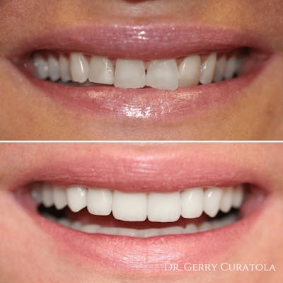 Cosmetic Services Gallery Before & After Gallery - Patient 215866 - Image 1