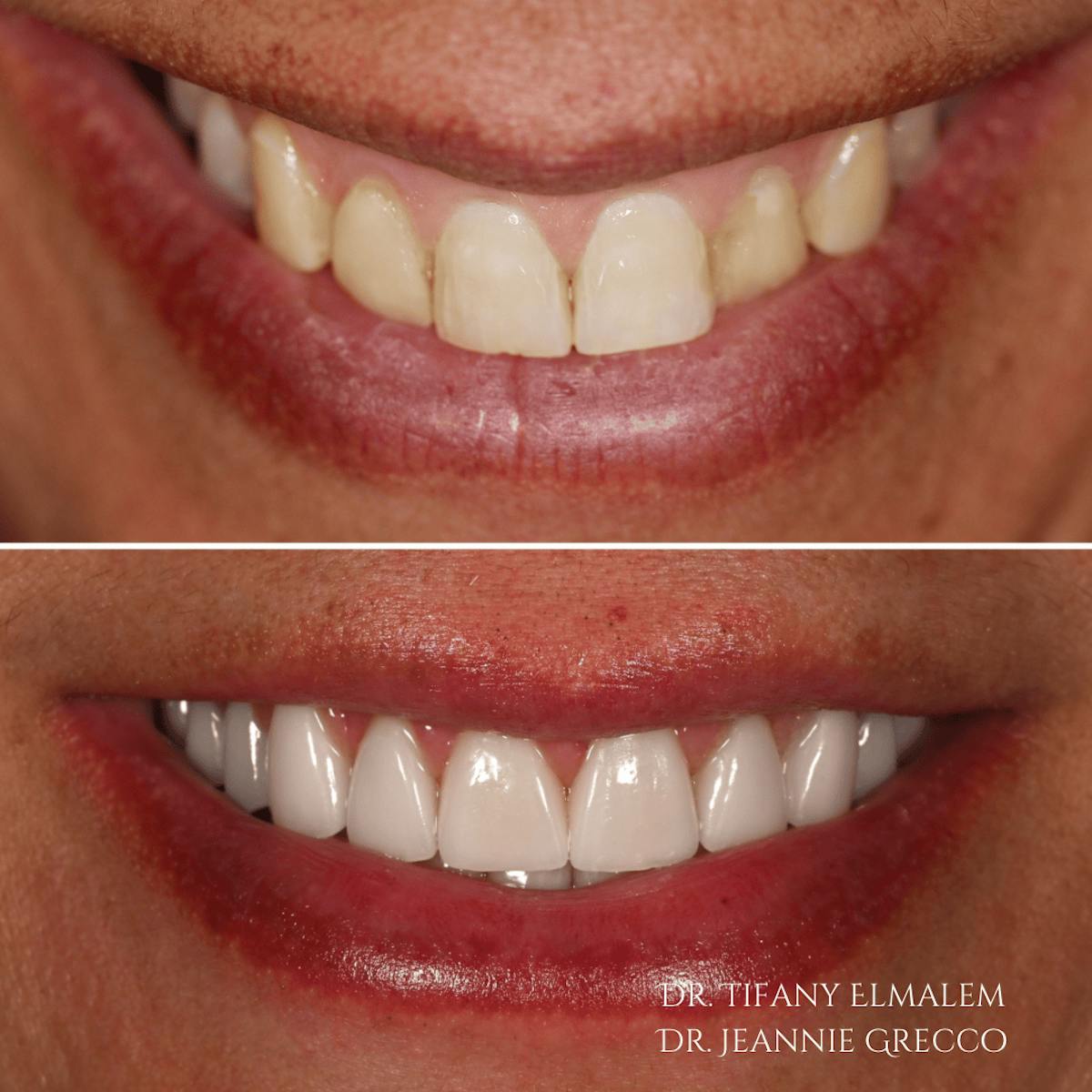 Cosmetic Services Gallery Before & After Gallery - Patient 234284 - Image 1